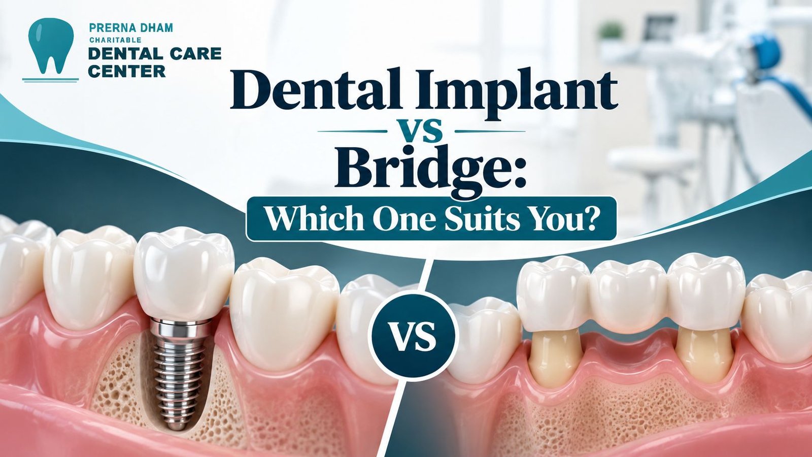 Dental Implant vs Bridge Which One Suits You